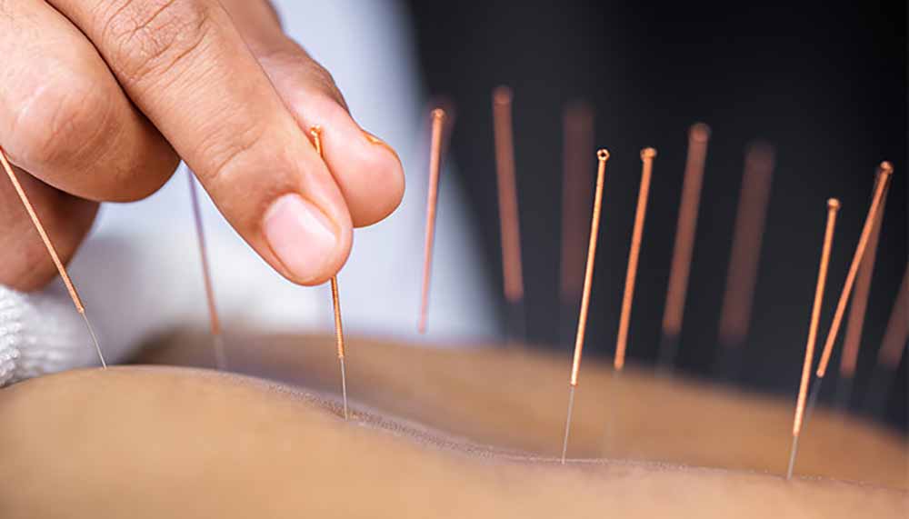 akupunktura-vnetje-mehurja